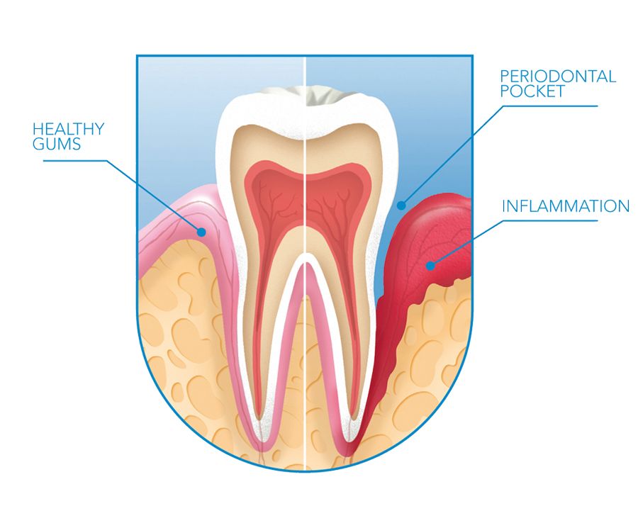 Pinhole® Surgical Technique - North Royalton, OH